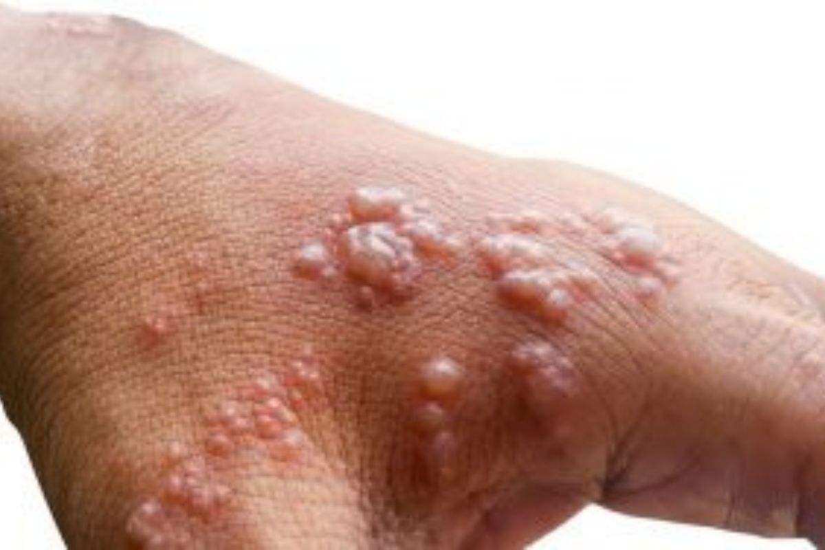 m-pox-virus:-मंकीपॉक्स-वायरस-के-कारण,-प्रभाव-और-उपचार