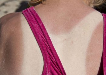 best-moisturisers-to-treat-sunburn-–-and-one-you-must-avoid