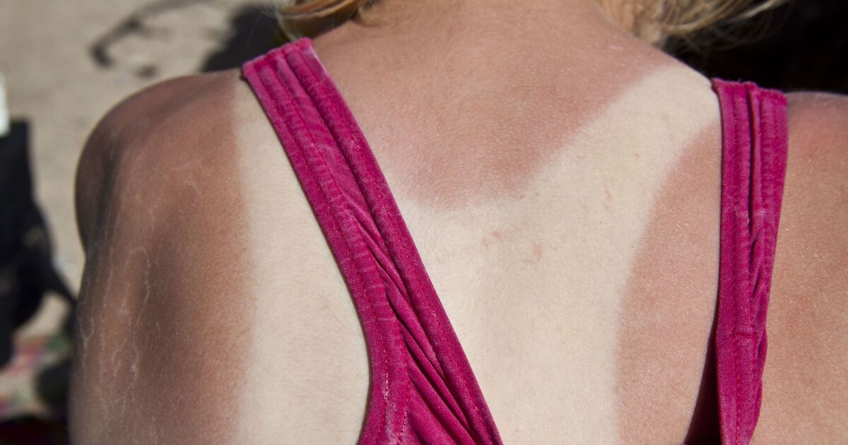 best-moisturisers-to-treat-sunburn-–-and-one-you-must-avoid