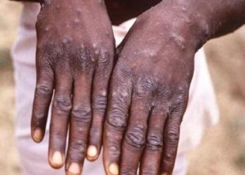 how-lack-of-coordination,-funding-issues-turned-mpox-into-a-global-crisis