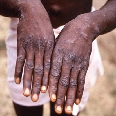 how-lack-of-coordination,-funding-issues-turned-mpox-into-a-global-crisis